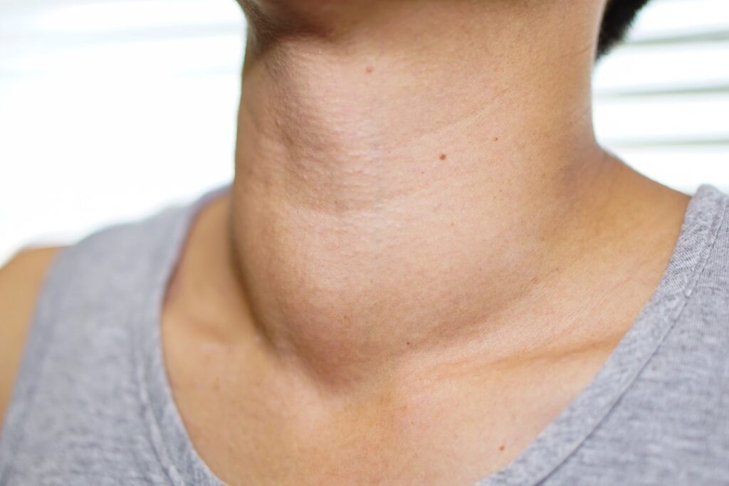 7 mitos e verdades sobre nódulos na tireoide