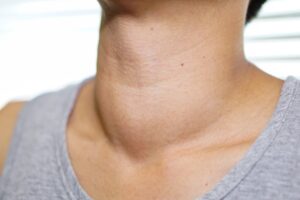7 mitos e verdades sobre nódulos na tireoide