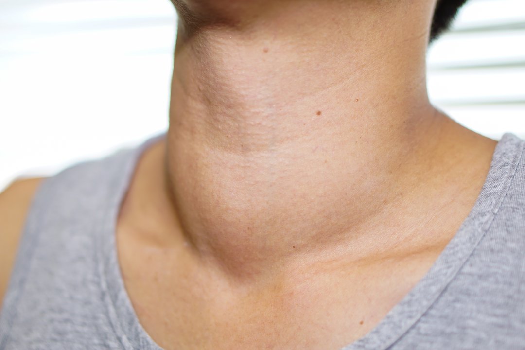 7 mitos e verdades sobre nódulos na tireoide