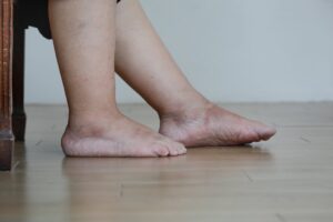 7 cuidados para evitar o pé diabético